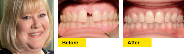 Before/After Marie’s Invisalign story