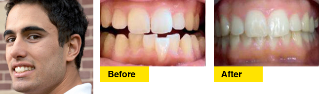 Before/After Davide’s Invisalign story