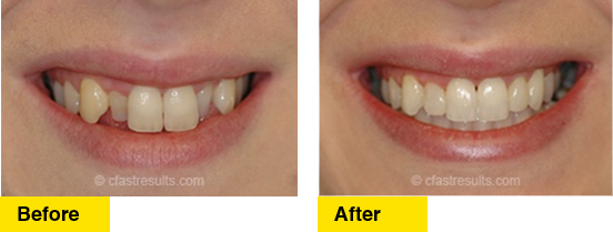 Before/After C Fast Orthodontic