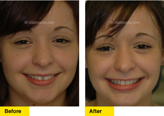 Before/After C Fast Orthodontic
