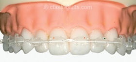 C Fast Orthodontic