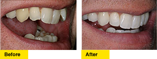 Before/After Uneven and Crowded Teeth