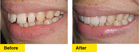 Before/After Alignment and Veneers